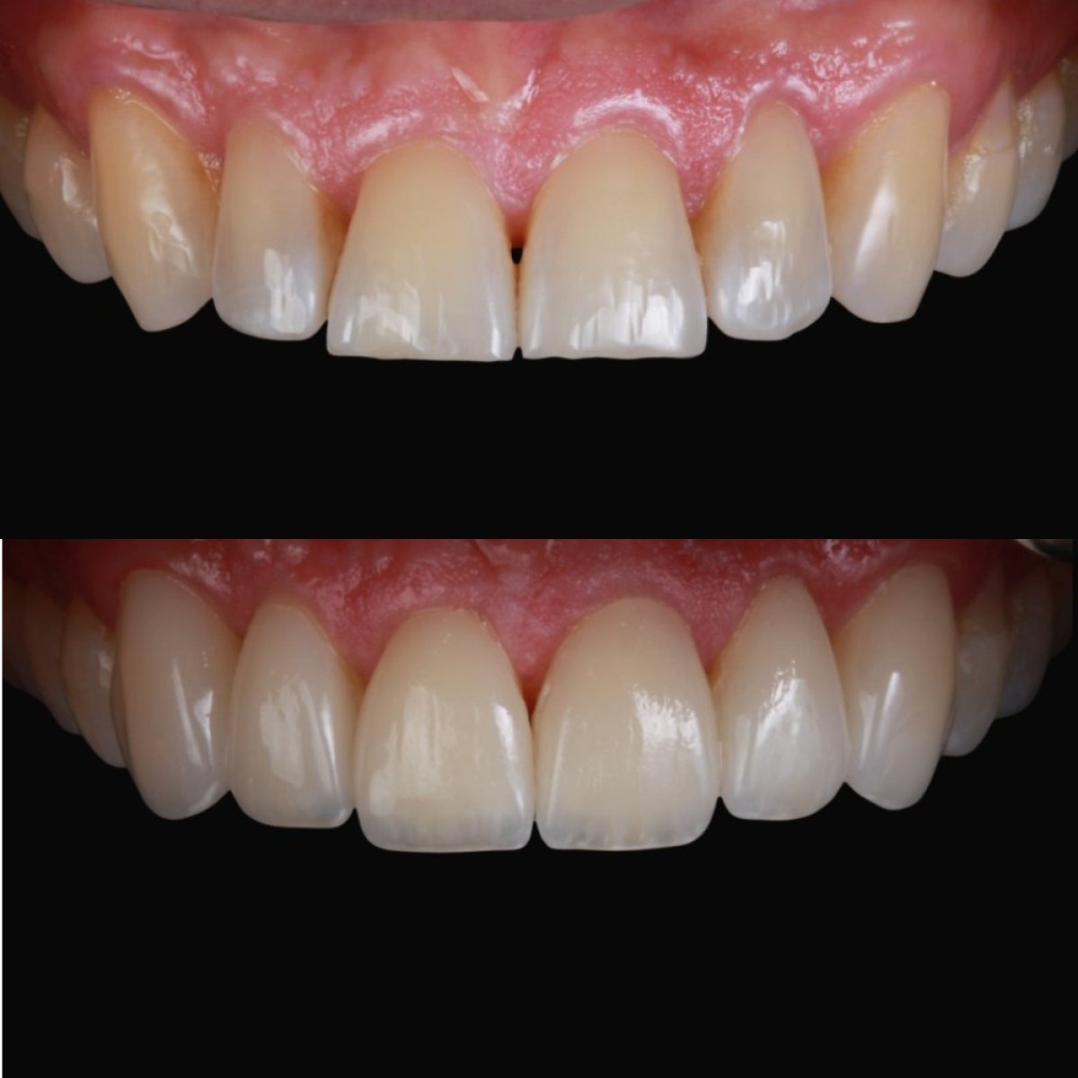 Before and after veneers at RO Dental Clinic – improved smile aesthetics and whiter teeth result