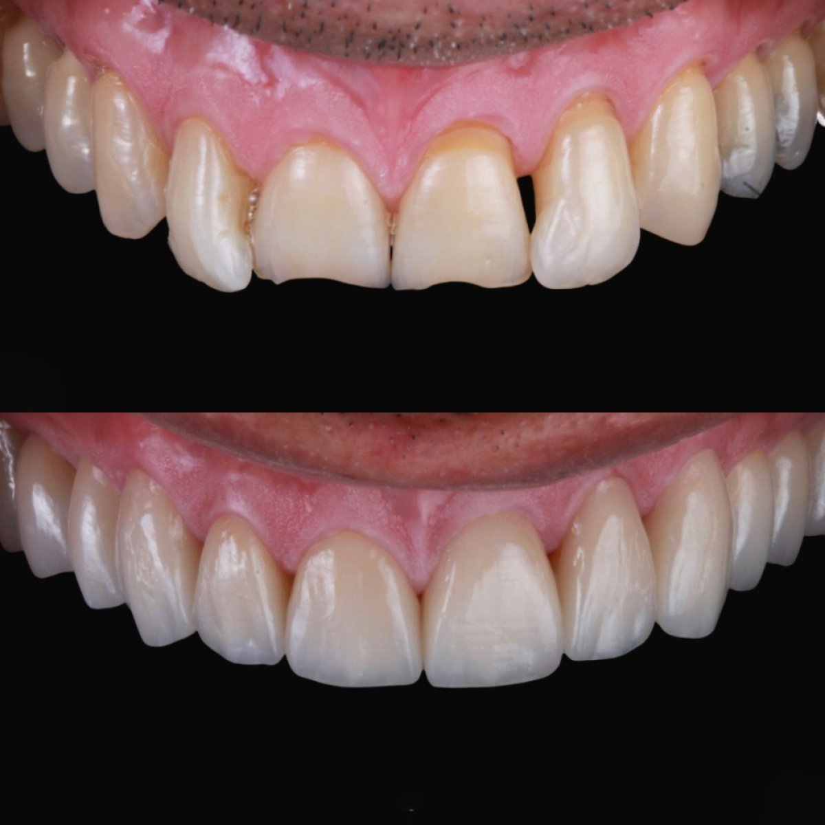 Before and after veneers at RO Dental Clinic – smile makeover with natural-looking results