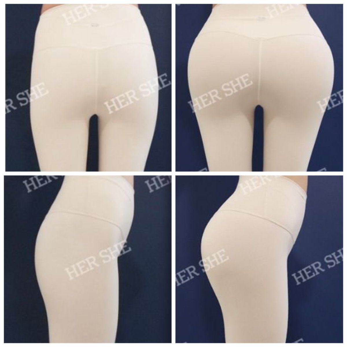 Résultats avant et après Brazilian Butt Lift chez HERSHE Plastic Surgery Korea, courbes améliorées