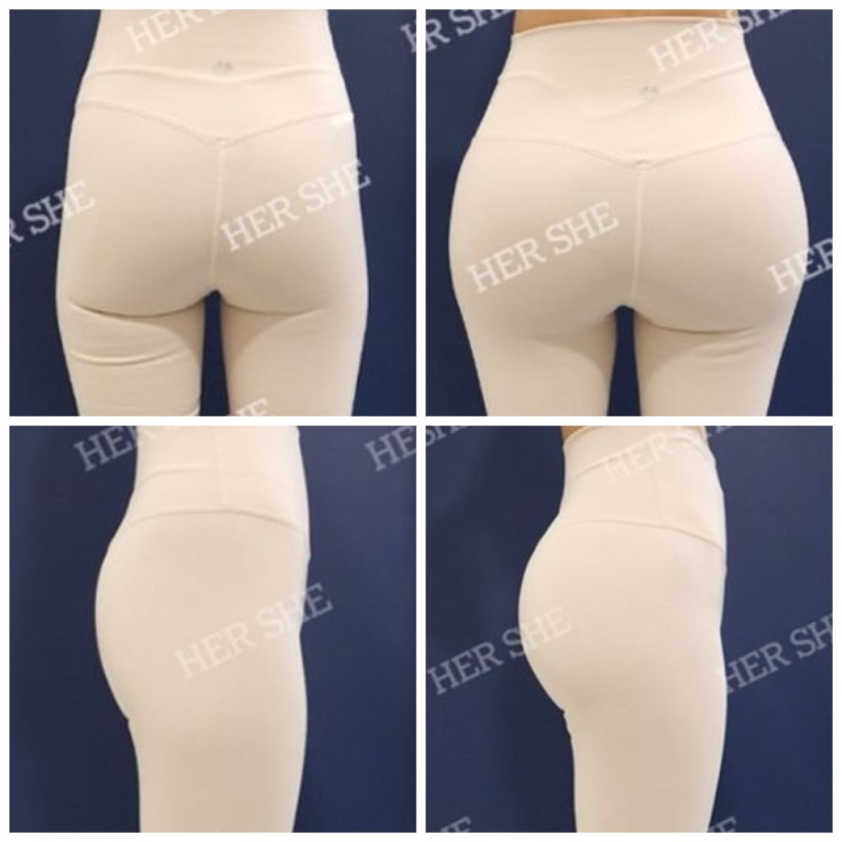 Résultats avant et après Brazilian Butt Lift chez HERSHE Plastic Surgery Korea, courbes améliorées