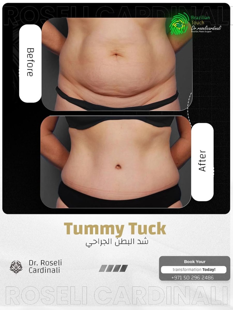 Before and after tummy tuck results at Dr. Roseli Cardinali clinic – flatter abdomen