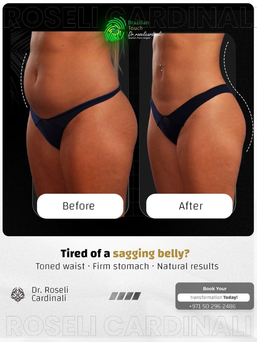 Before and after tummy tuck results at Dr. Roseli Cardinali – firmer, flatter abdomen
