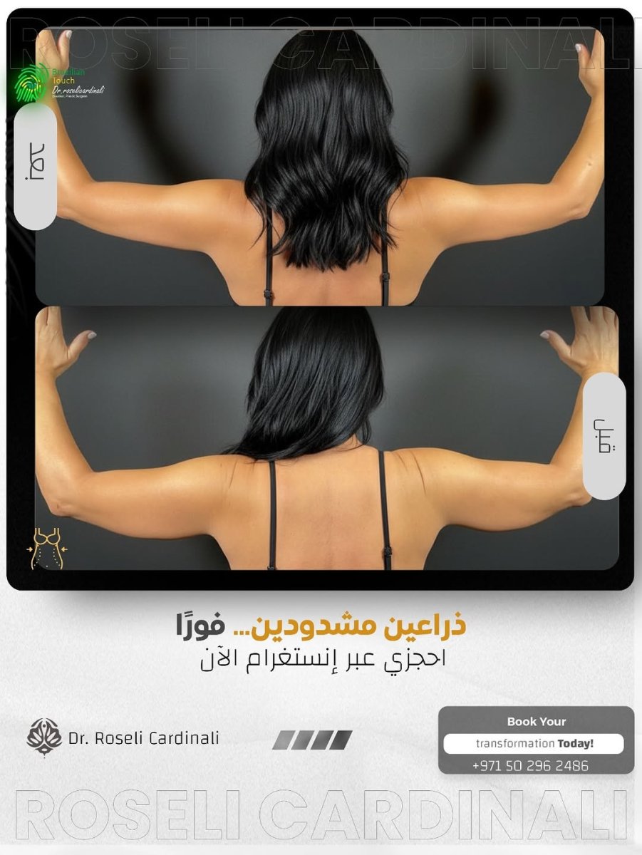 Before and after arm lift (brachioplasty) results at Dr. Roseli Cardinali clinic