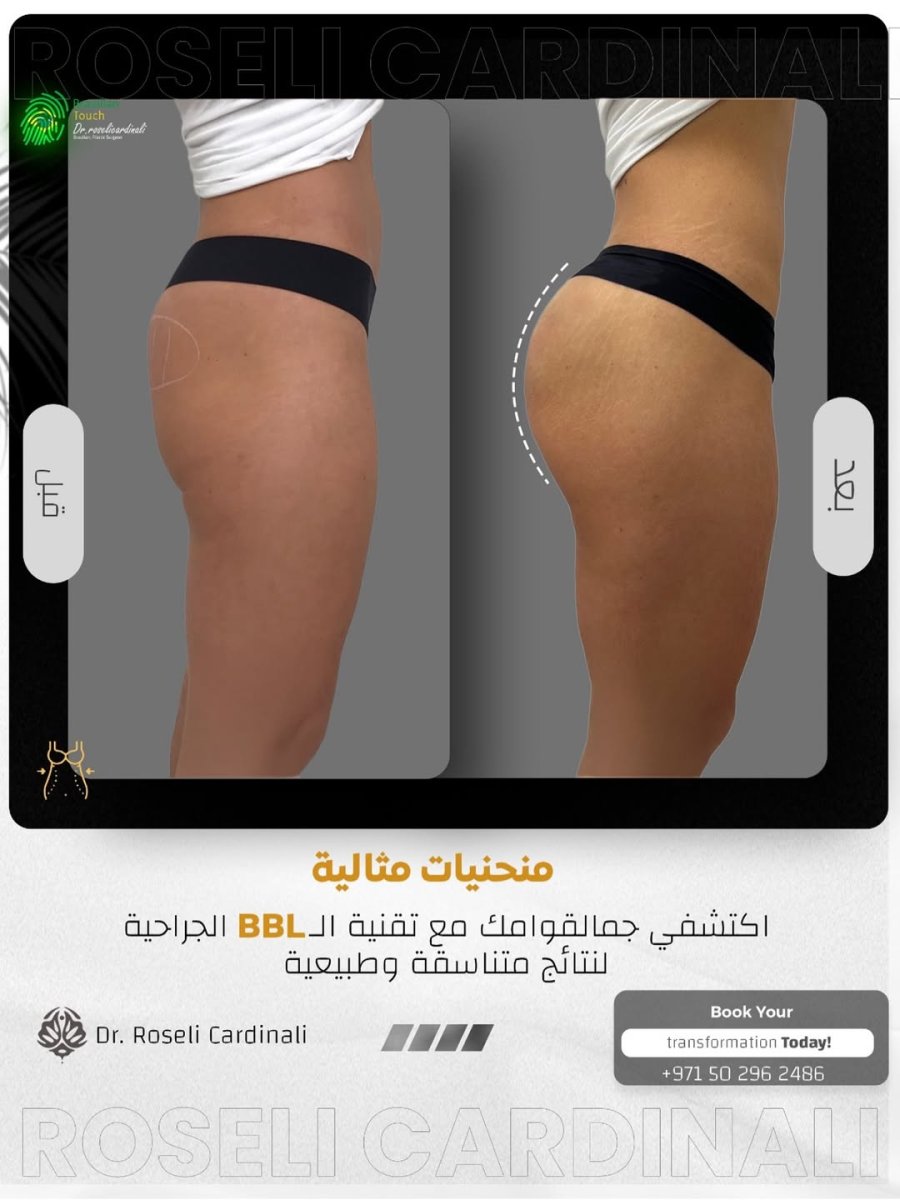 Before and after Brazilian Butt Lift results at Dr. Roseli Cardinali clinic, enhanced curves