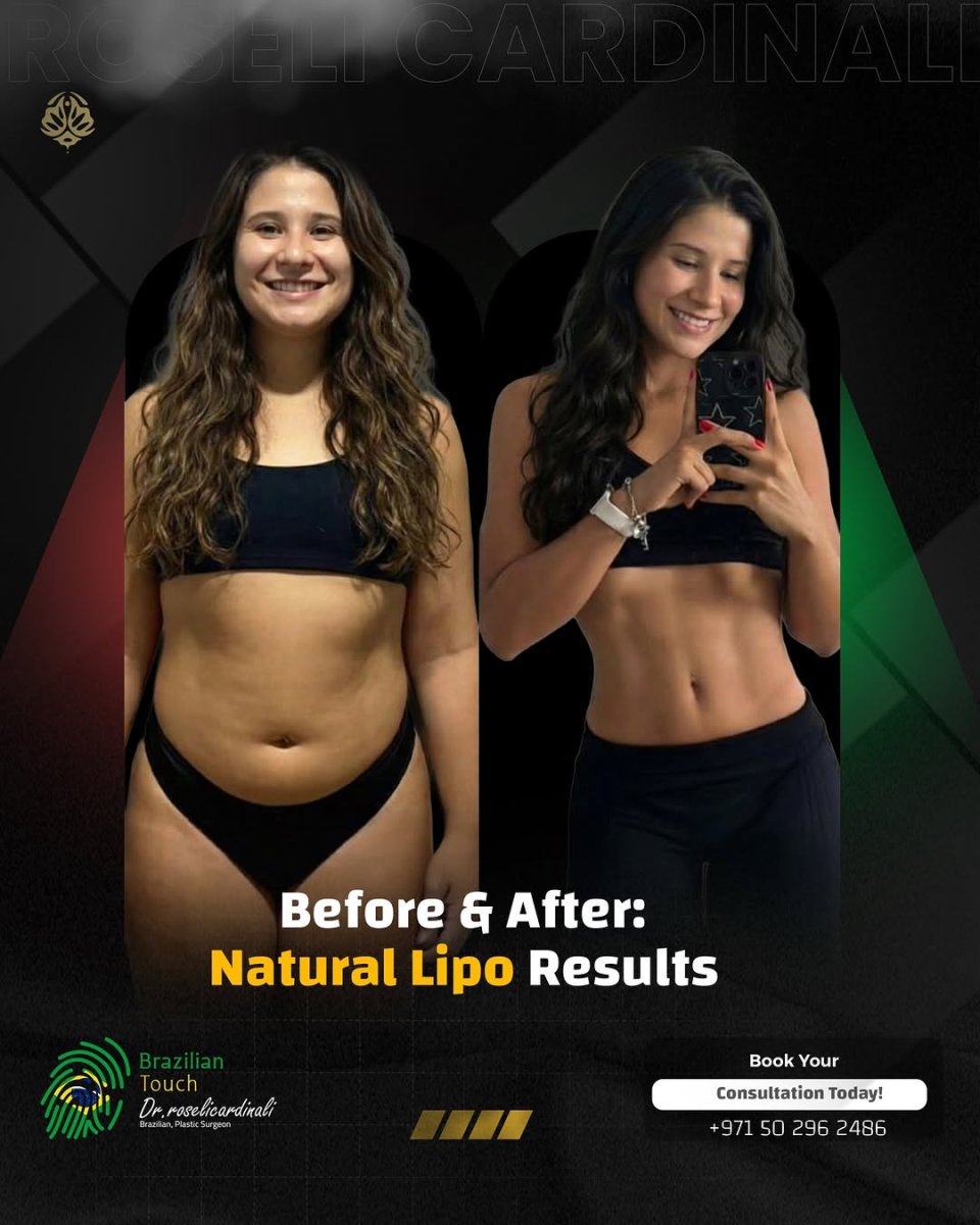Before and after liposuction results at Brazilian Touch, visible body contour improvement