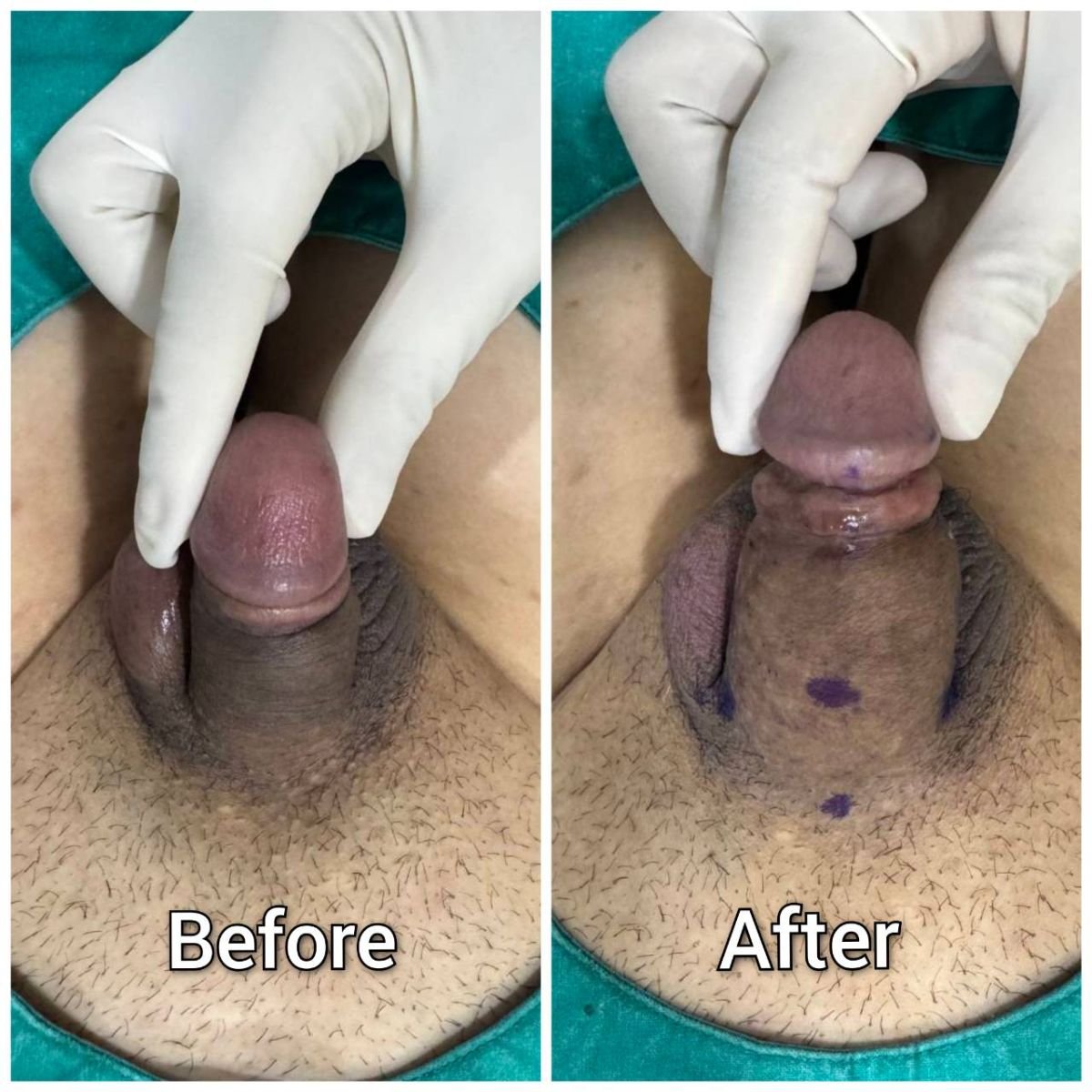 نتائج تكبير القضيب قبل وبعد في Eternity Clinic Pleonchit، زيادة ملحوظة بالحجم