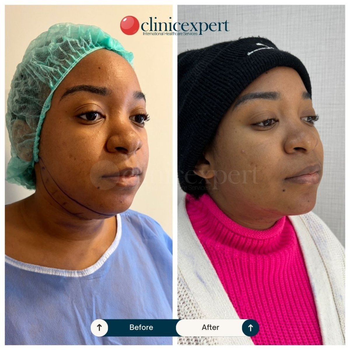Resultados de minilifting facial antes y después en CE International Hospital, contorno visible