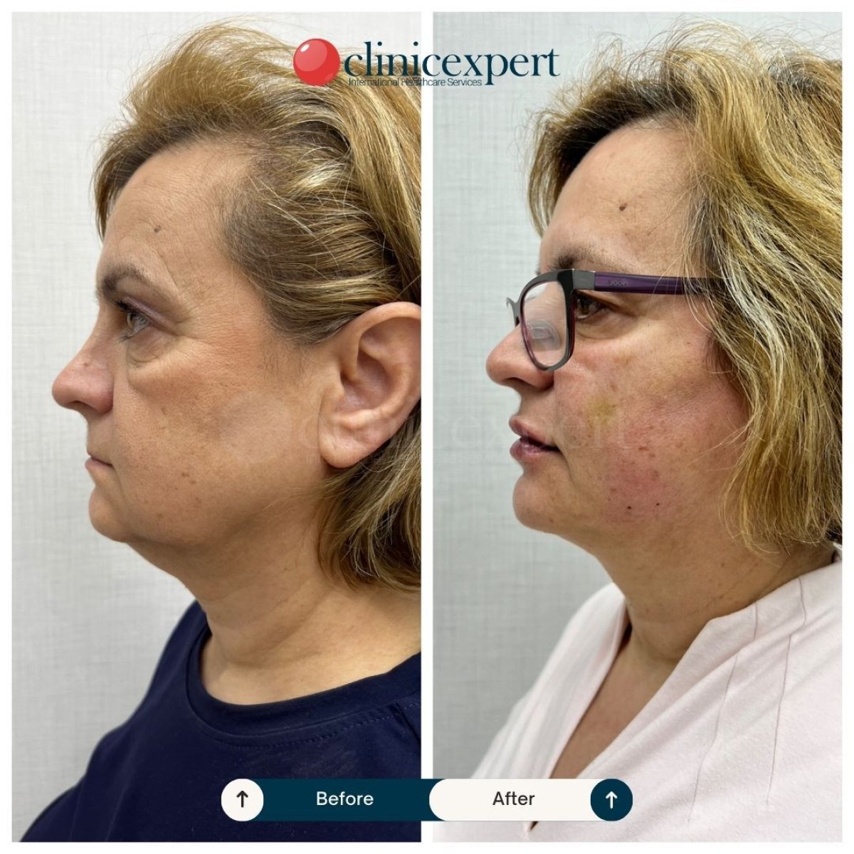 Resultados de minilifting facial antes y después en CE International Hospital, rejuvenecimiento