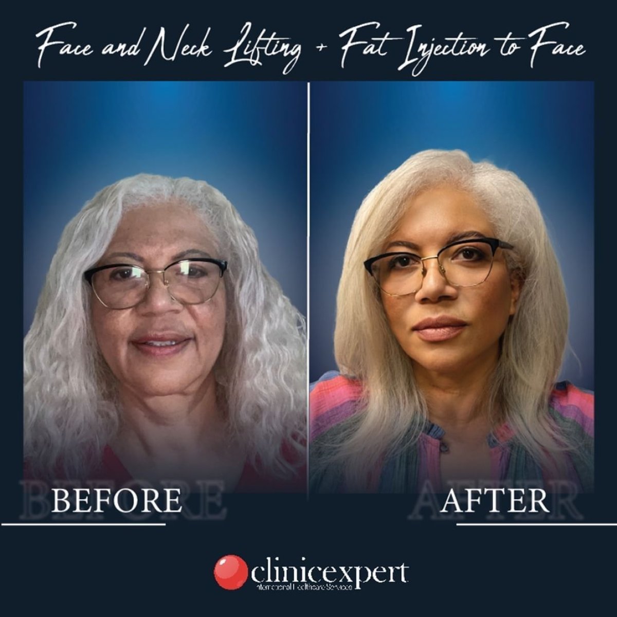 Resultados antes y después de minilifting facial y lipofilling en CE International Hospital