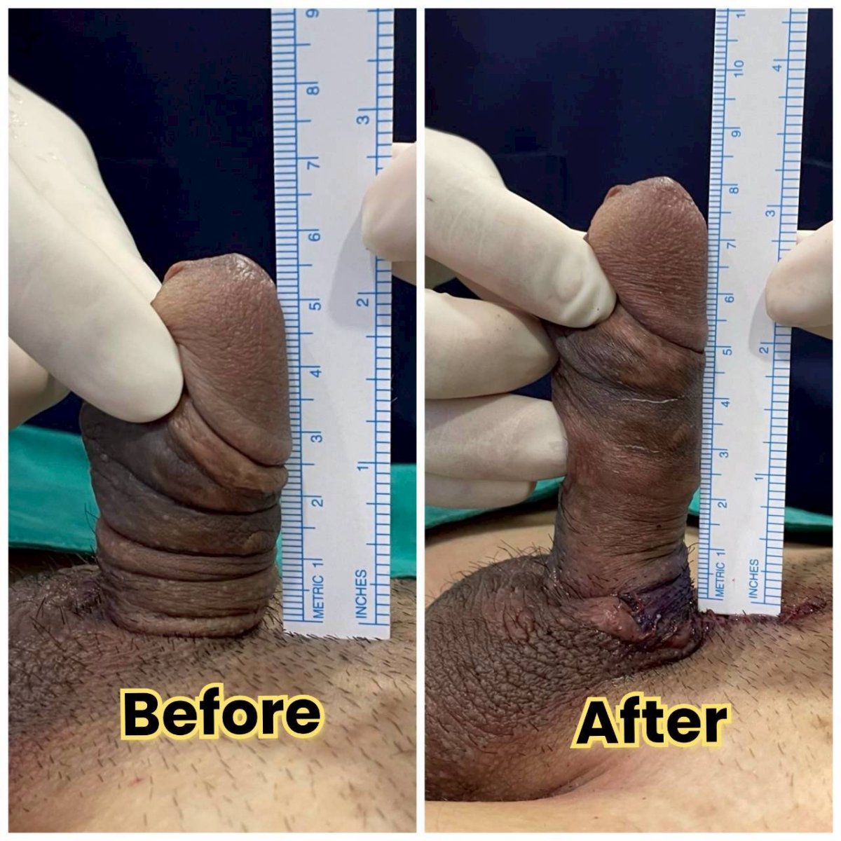 Before and after surgical penile lengthening results at Eternity Clinic Pleonchit, increased length