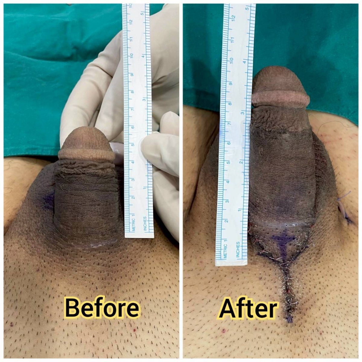 نتائج قبل وبعد إطالة القضيب الجراحية في Eternity Clinic Pleonchit، زيادة الطول