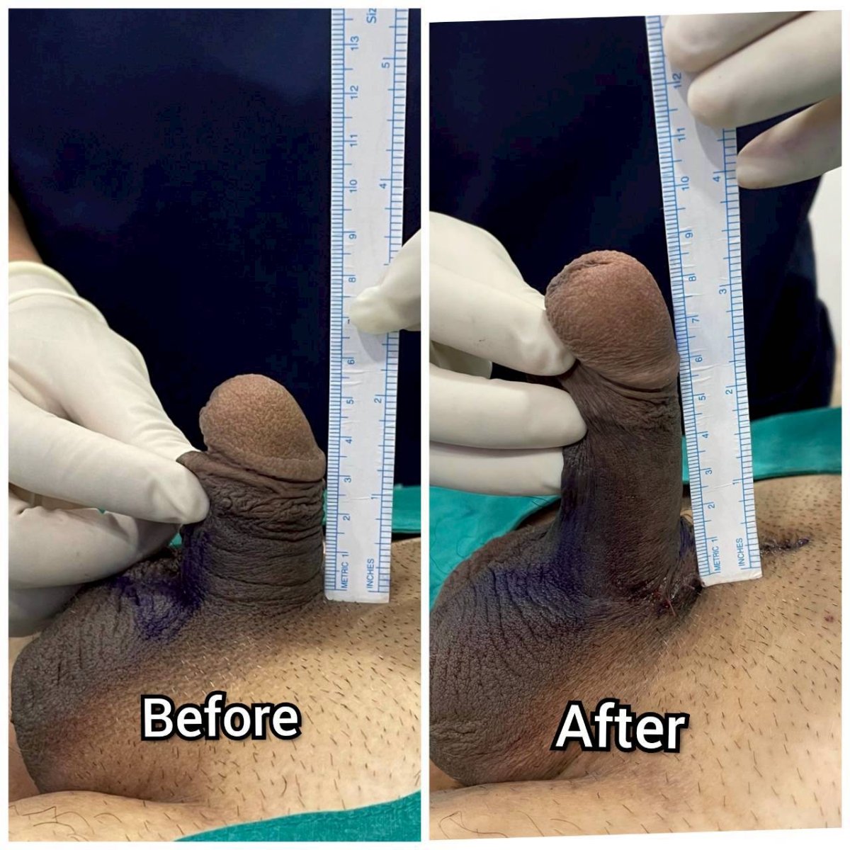Before and after surgical penile lengthening results at Eternity Clinic Pleonchit, increased length