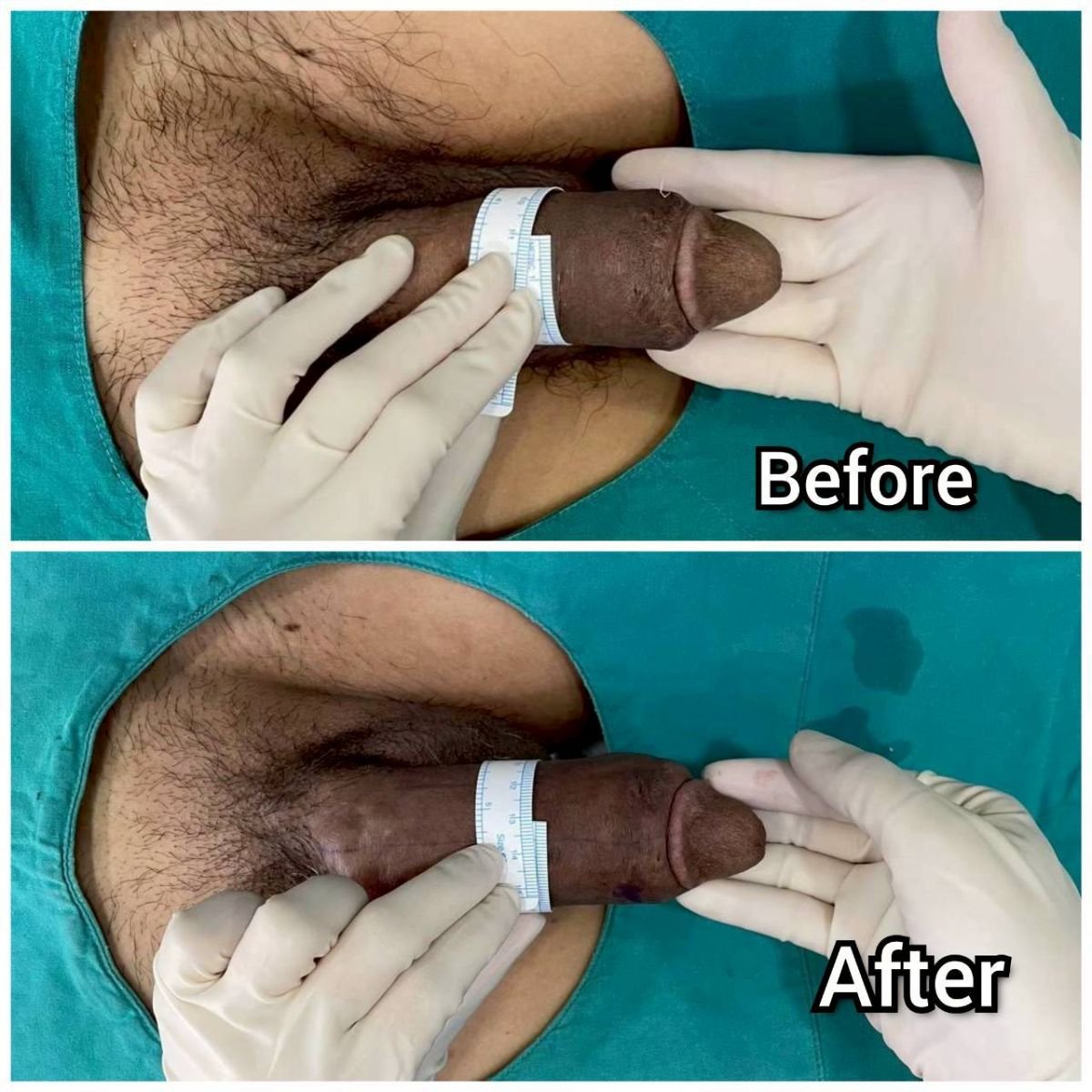 Resultados de aumento de pene antes y después en Eternity Clinic Phuket By Dr.Beer, mayor grosor