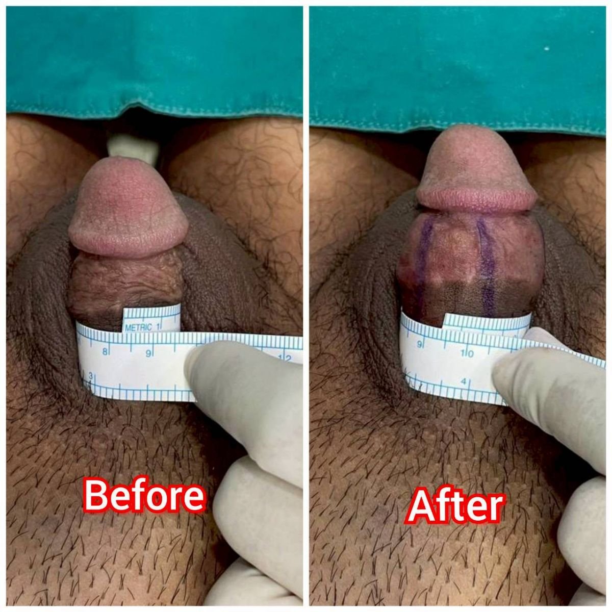 Before and after penis enlargement results at Eternity Clinic Phuket By Dr.Beer, increased girth