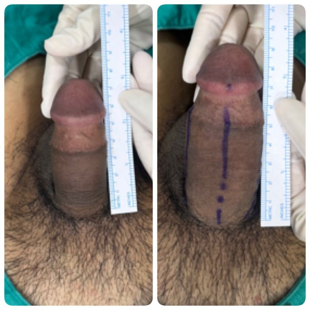 نتائج تكبير القضيب قبل وبعد في Eternity Clinic Phuket By Dr.Beer، زيادة الطول واضحة