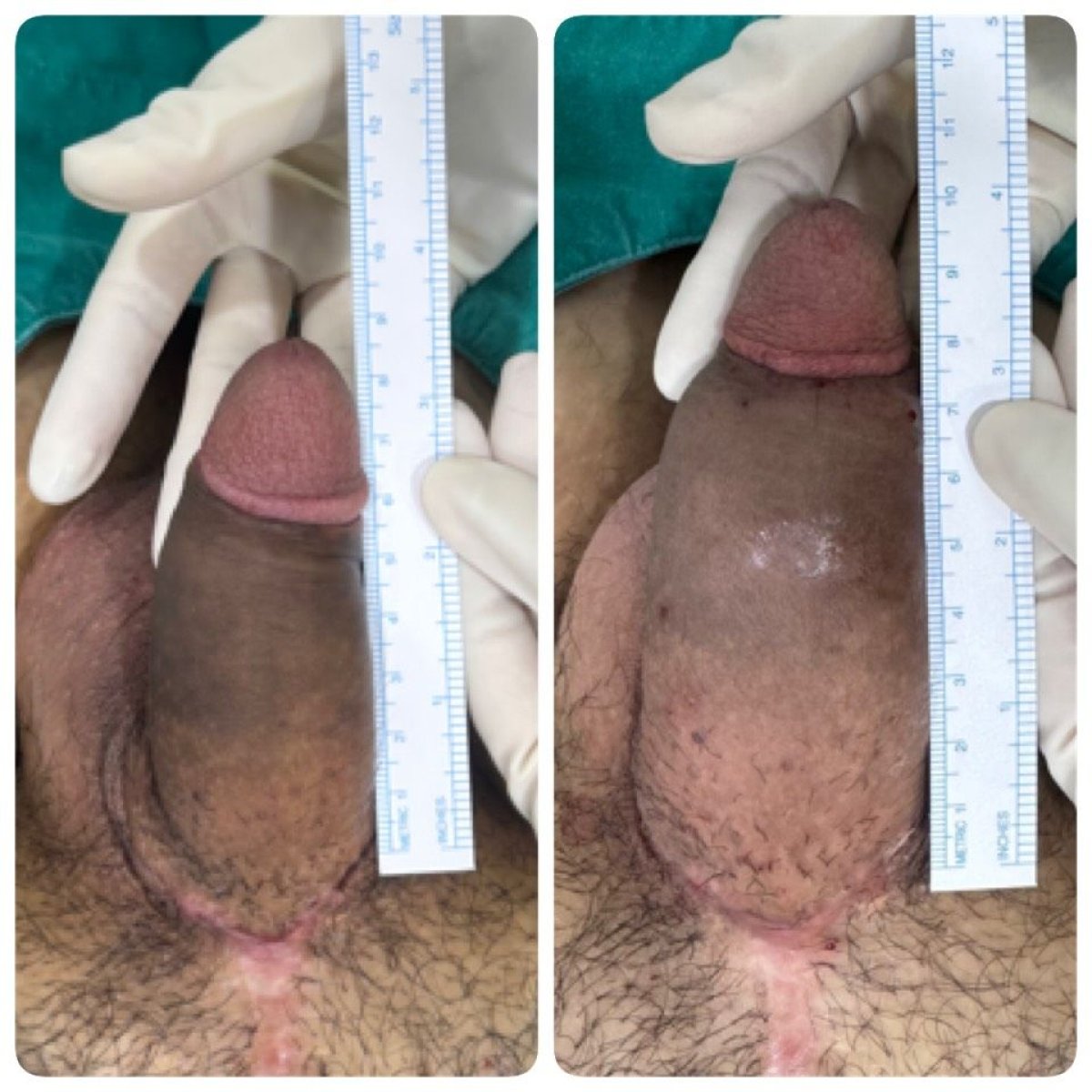 Before and after penis enlargement results at Eternity Clinic Phuket By Dr.Beer, visible length gain