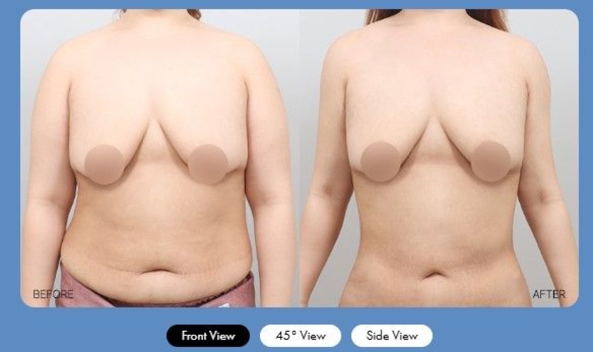 Before and after liposuction results at AB Plastic Surgery Clinic, improved abdominal contour