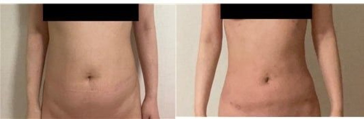 نتائج شفط الدهون قبل وبعد في AB Plastic Surgery Clinic، تحسين شكل البطن