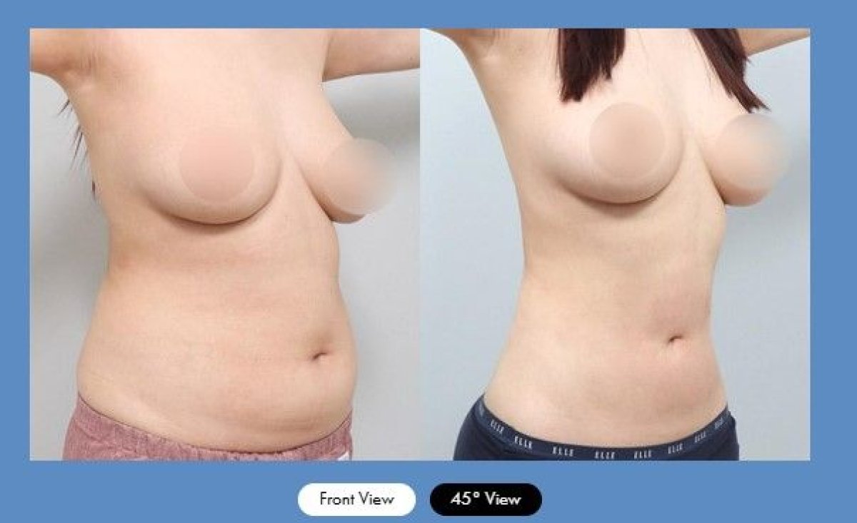نتائج شفط الدهون قبل وبعد في AB Plastic Surgery Clinic، تحسين شكل البطن