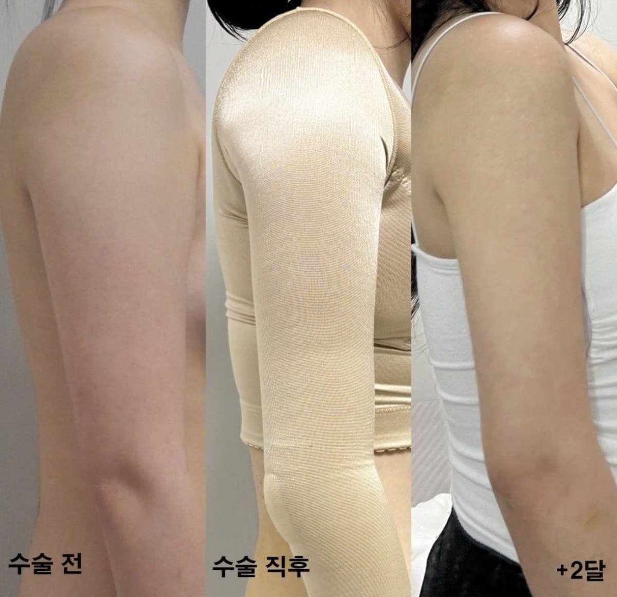 Arm liposuction before and after results at AB Plastic Surgery Clinic, slimmer arm contour