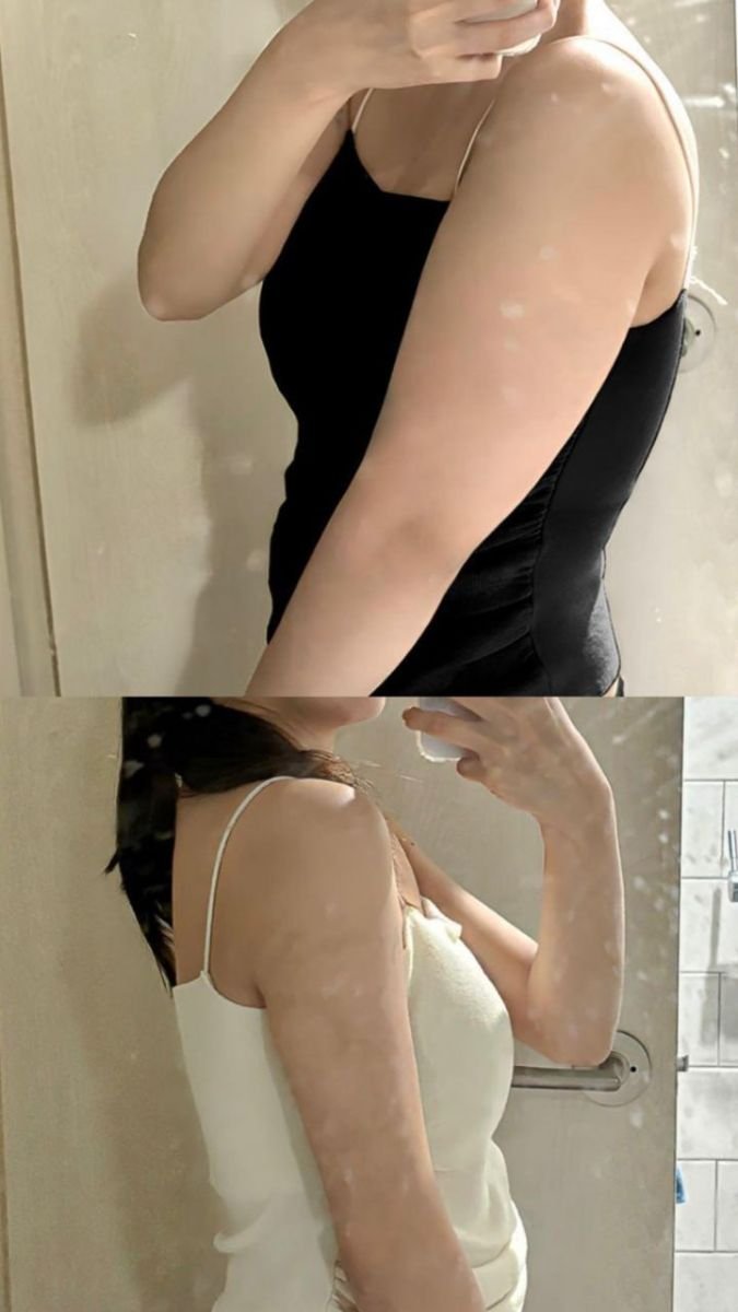 نتائج شفط دهون الذراعين قبل وبعد في AB Plastic Surgery Clinic، ذراع أنحف