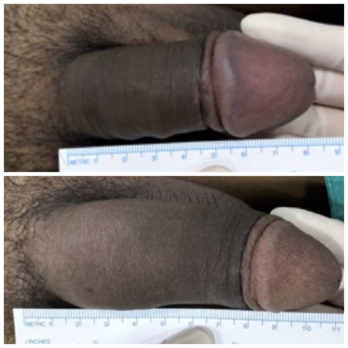 Resultados antes y después de aumento de pene en Eternity Clinic Phuket By Dr.Beer, aumento visible