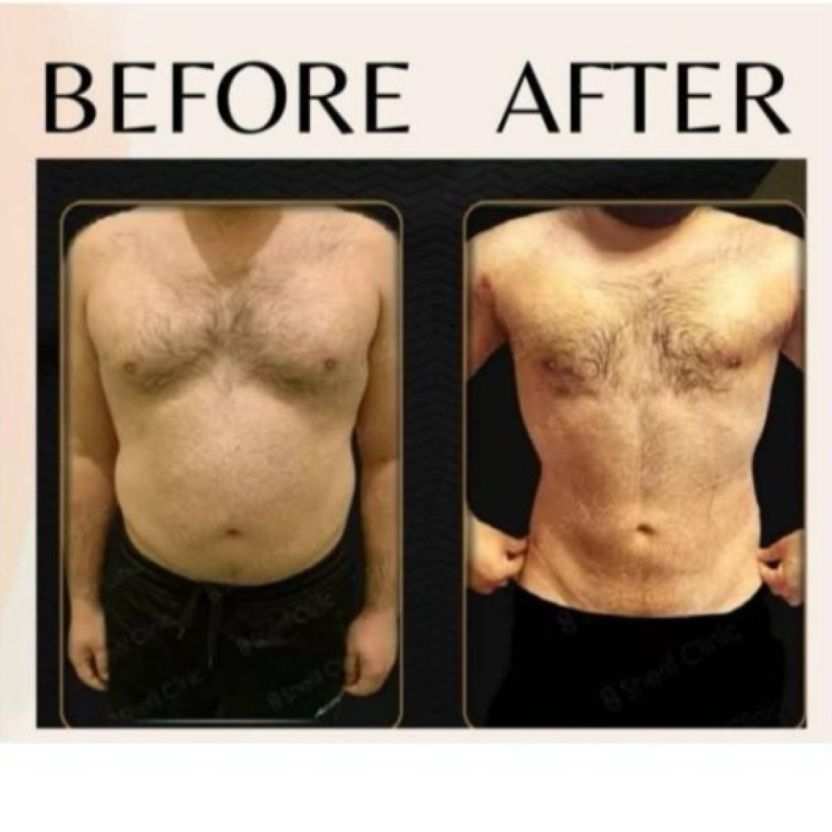Before and after love handles liposuction result at ID Clinic Bangkok, improved waist contour