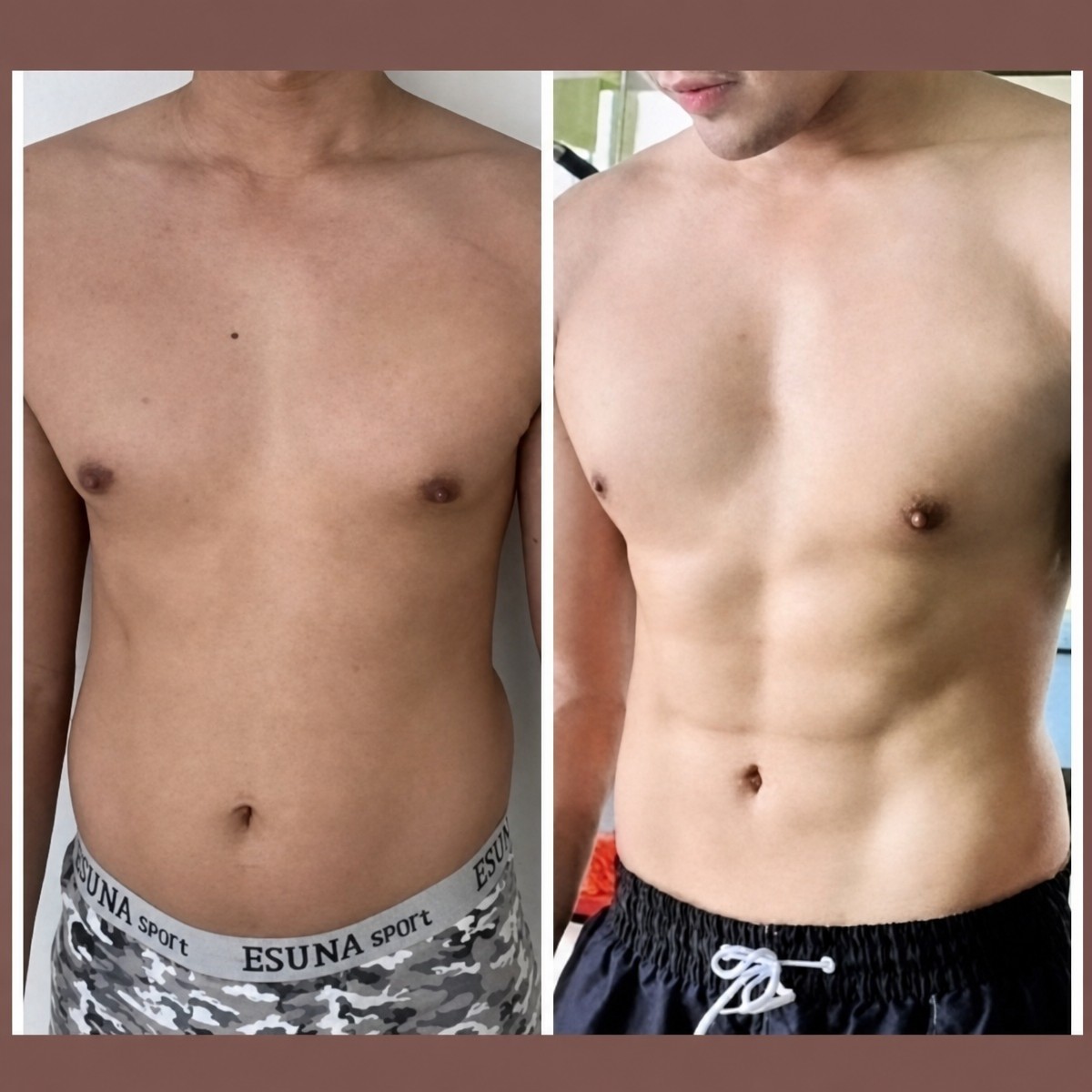 Before and after love handles liposuction result at ID Clinic Bangkok, improved body contour