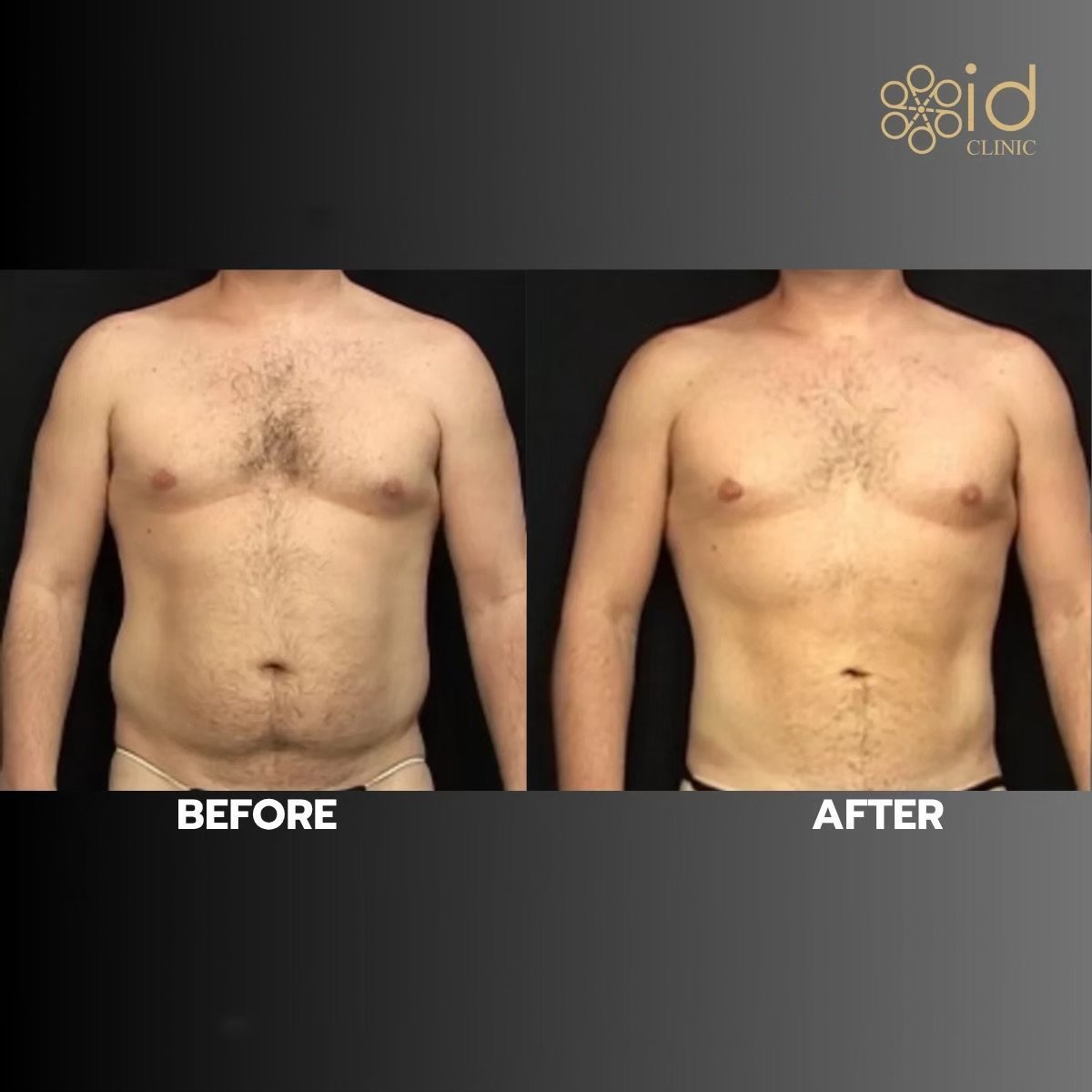 Before and after love handles liposuction result at ID Clinic Bangkok, improved body contour