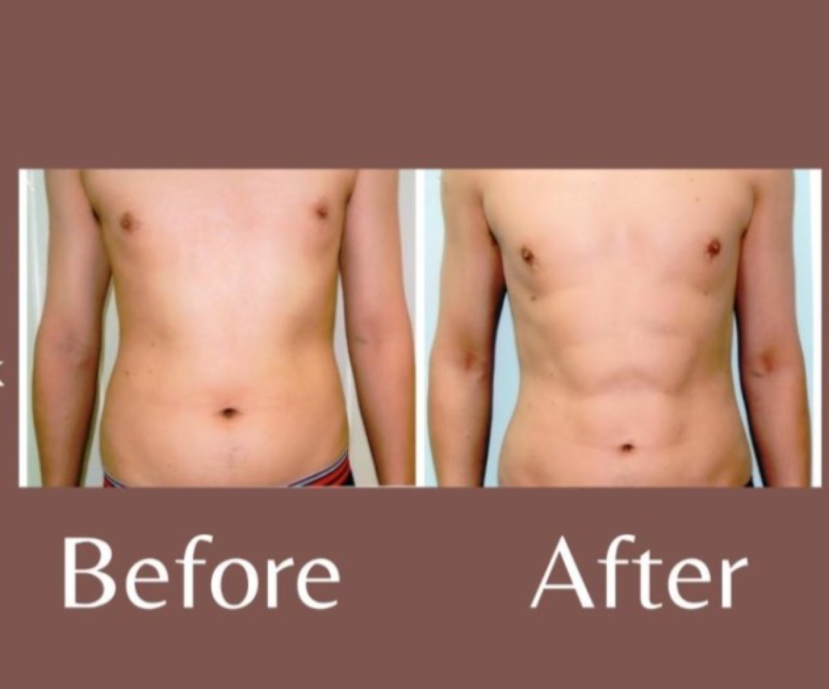 Before and after love handles liposuction result at ID Clinic Bangkok – improved waist contour