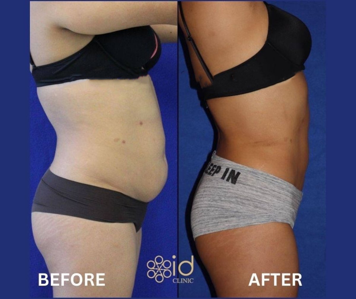 360 liposuction before and after results at ID Clinic Bangkok, visible body contour improvement