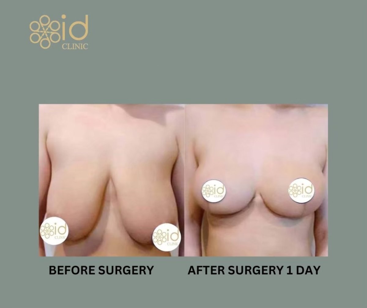Before and after breast lift results at ID Clinic Bangkok – visible lift and contour improvement