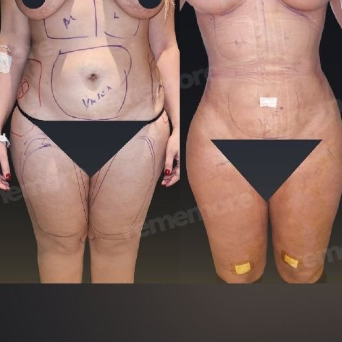 نتائج قبل وبعد عملية Brazilian Butt Lift في مستشفى Memorial Göztepe، تحسين شكل الجسم