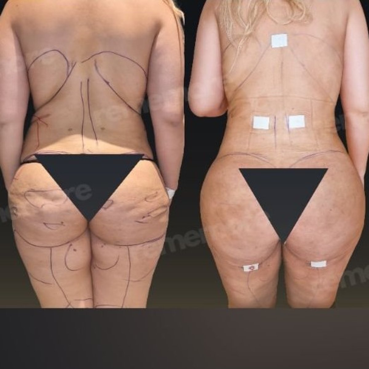 نتائج قبل وبعد عملية Brazilian Butt Lift في مستشفى Memorial Göztepe، تحسين شكل الجسم