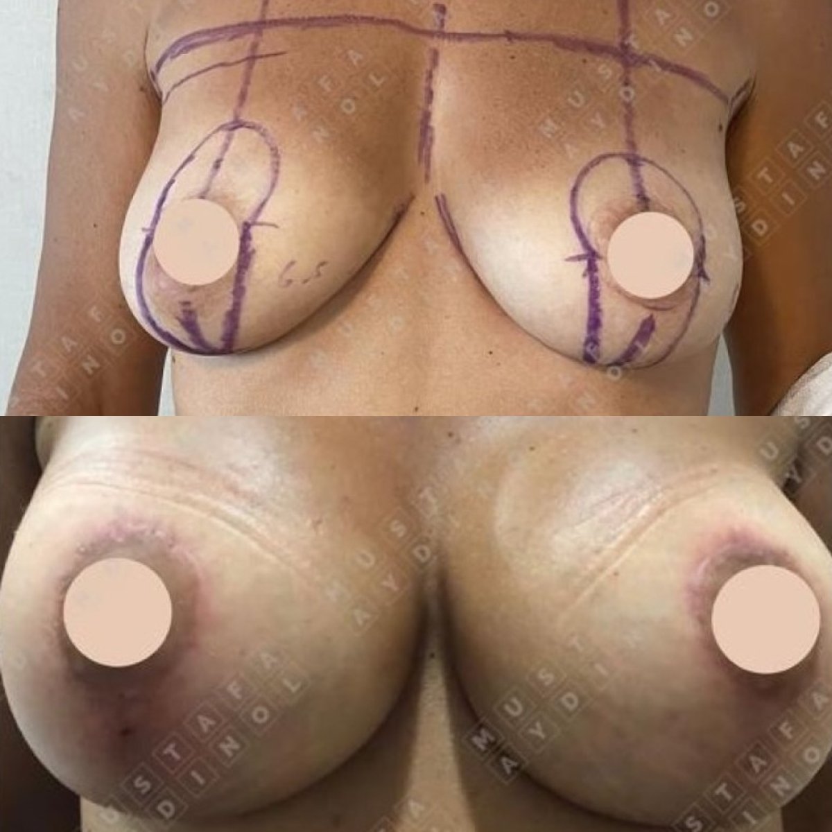 نتائج قبل وبعد تكبير الثدي في Dr. MED – تحسين شكل وحجم الثدي