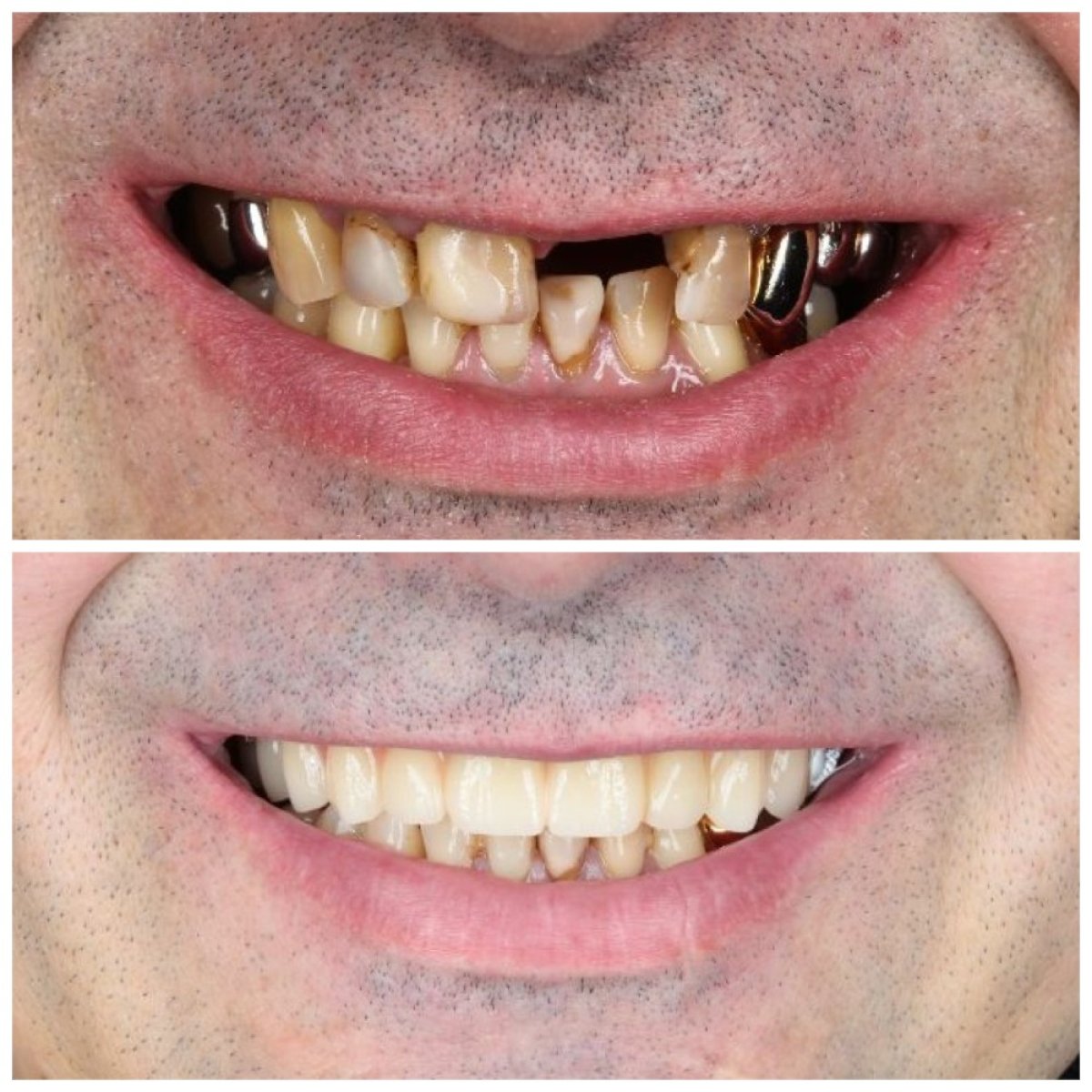 Before and after All-on-4 dental implants result at Dental Clinic Dynasty Stomatology Krakow
