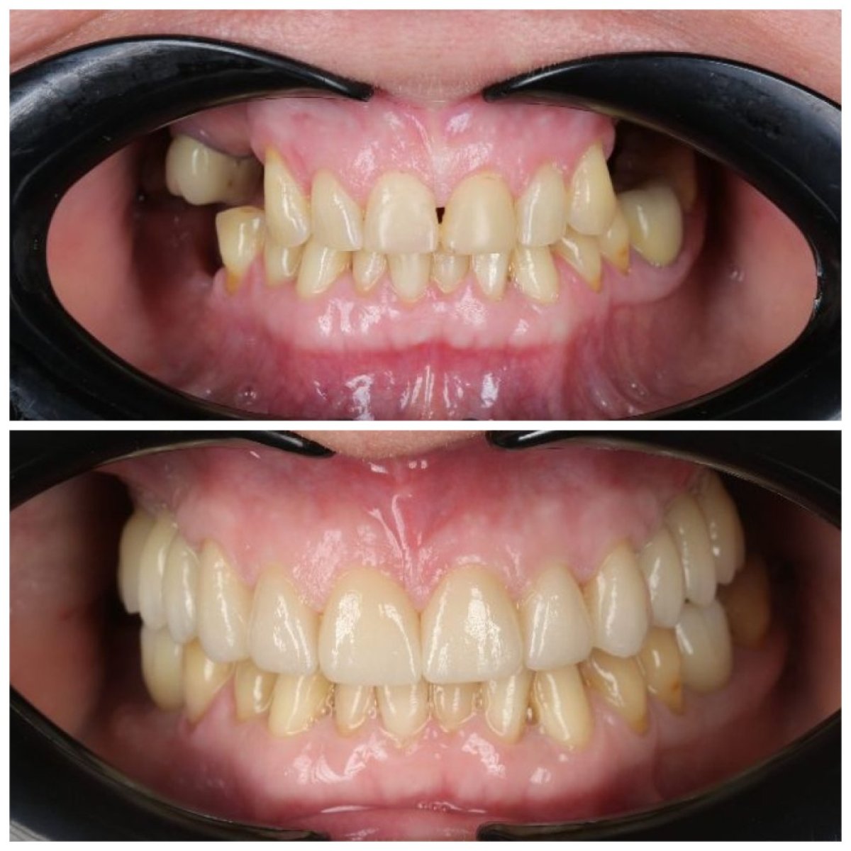 نتائج زراعة الأسنان قبل وبعد في عيادة Dynasty Stomatology في براغ