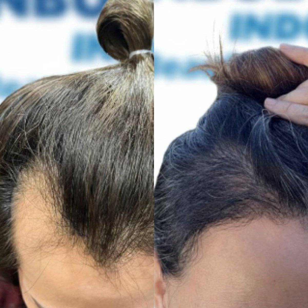 Resultados de trasplante capilar antes y después en Istanbul Hair Indonesia, mayor densidad
