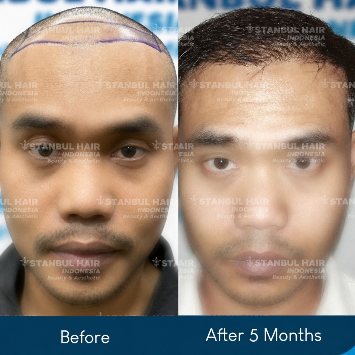 Resultado de trasplante capilar antes y después de 5 meses en Istanbul Hair Indonesia, línea restaurada