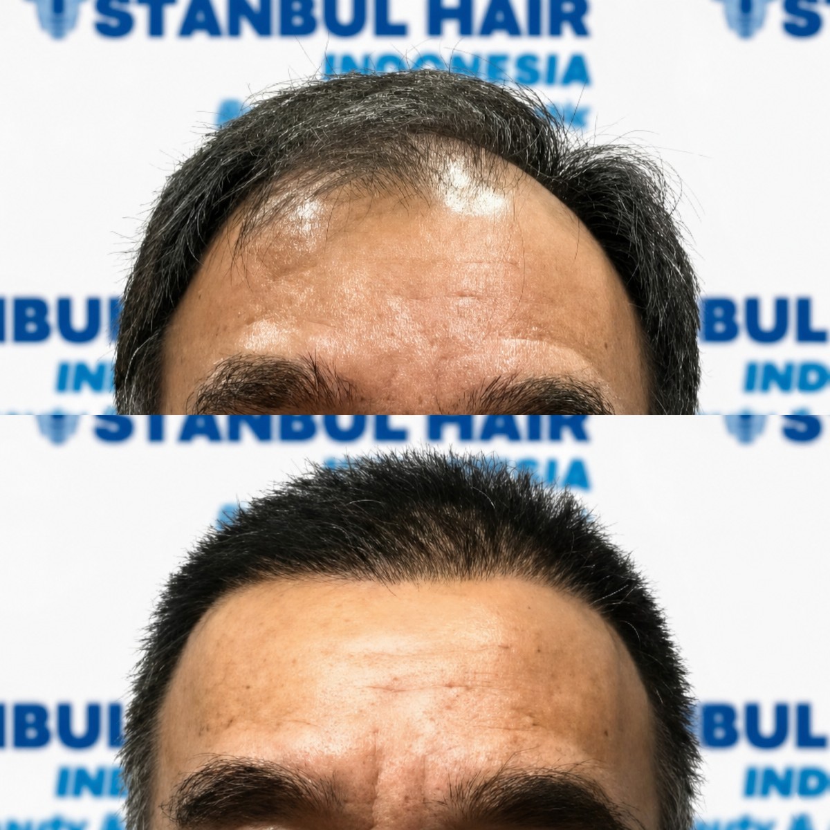 Результати пересадки волосся до і після в Istanbul Hair Indonesia, відновлена лінія волосся у чоловіка
