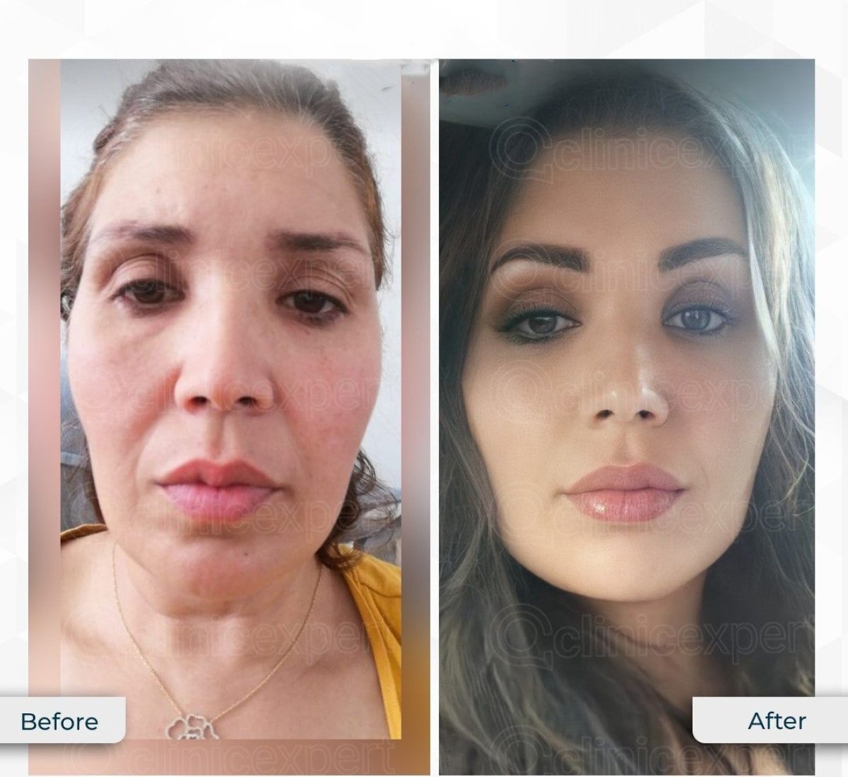 Resultados de minilifting facial antes y después en CE International Hospital, rejuvenecimiento visible
