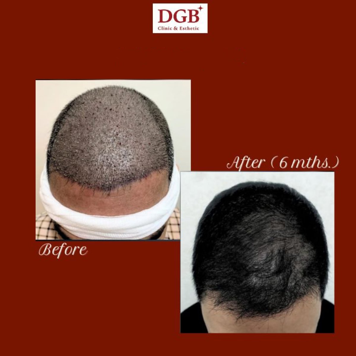 Avant et après greffe de cheveux à la DGB Clinic – repousse visible après 6 mois