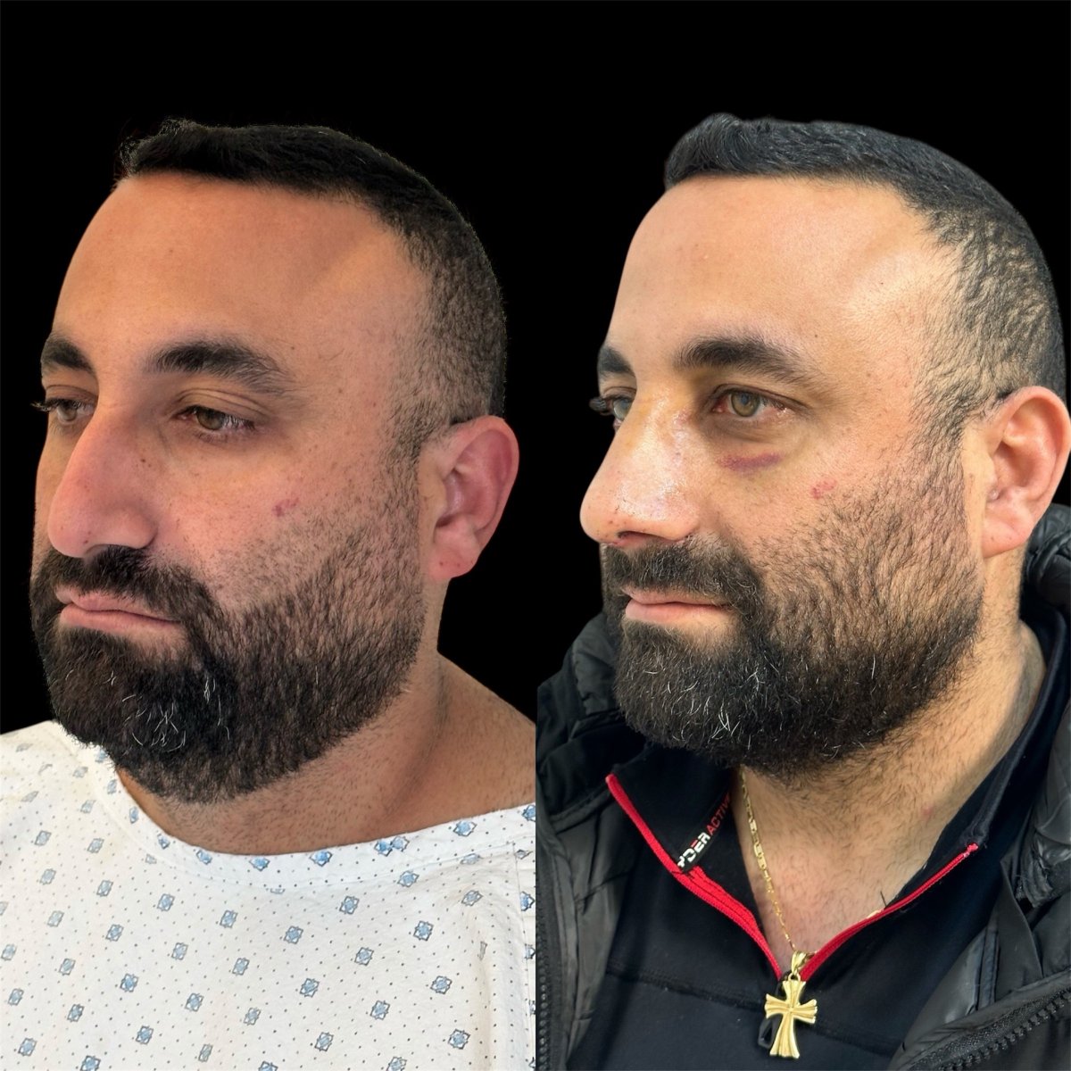 Resultados de rinoplastia antes y después en Dr. Michel Salameh - Plastic And Aesthetic Surgery