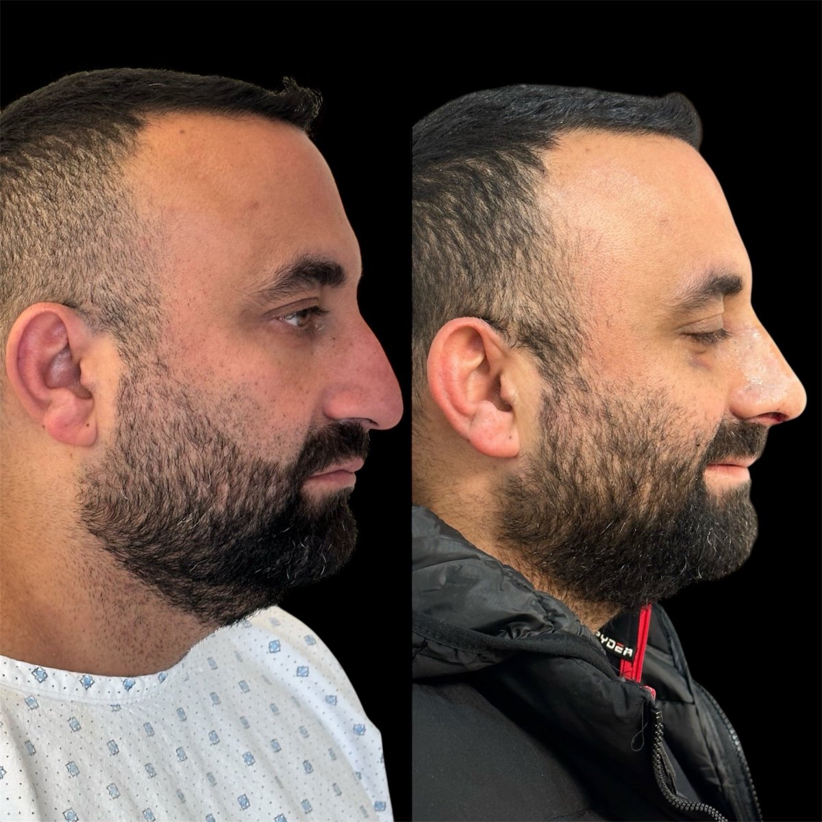 Résultats avant et après rhinoplastie chez Dr. Michel Salameh - Plastic And Aesthetic Surgery
