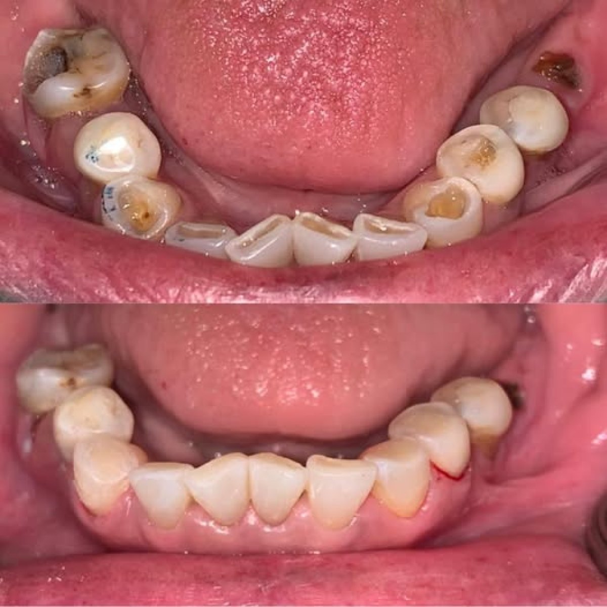 Vorher-nachher-Ergebnis Kompositveneers bei Bangkok Dental Hospital, Unterkieferrestauration