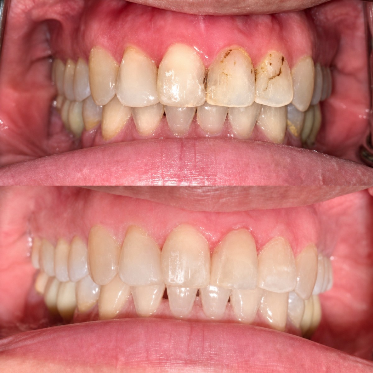 Before and after composite veneer results at Bangkok Dental Hospital, improved smile aesthetics