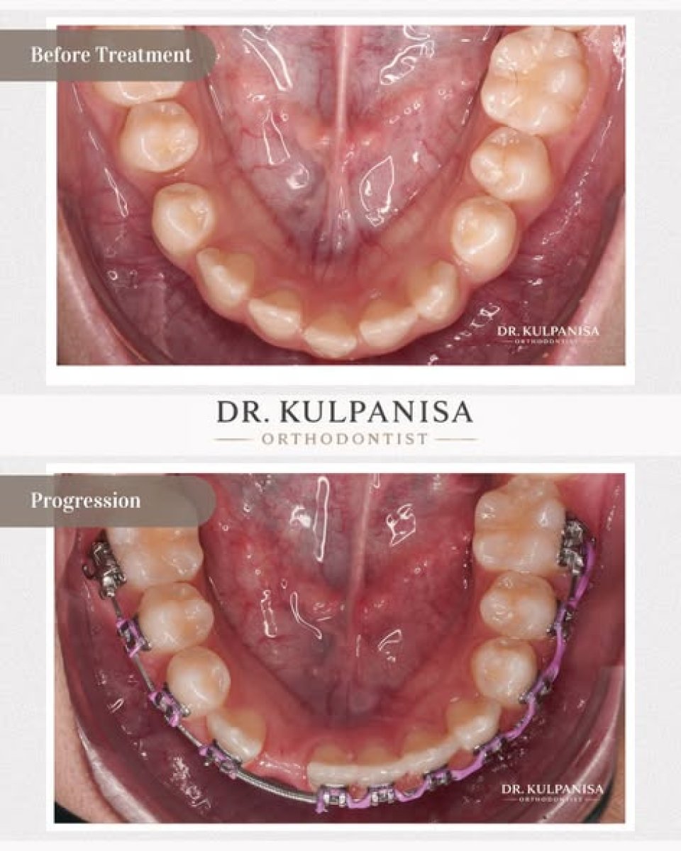 Before and after Damon braces results at Bangkok Dental Hospital, visible teeth alignment progress