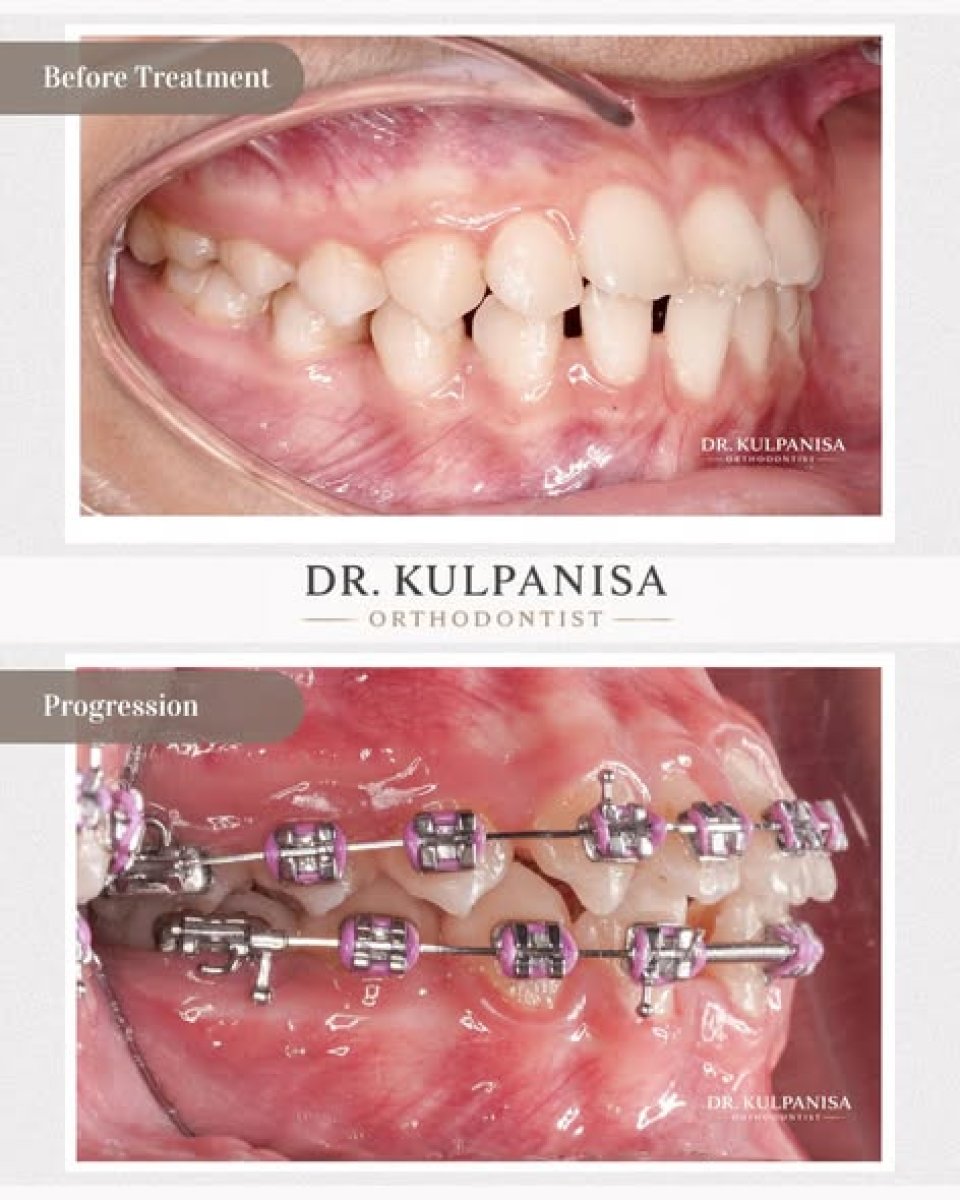 Damon braces treatment progress at Bangkok Dental Hospital, teeth alignment improvement result