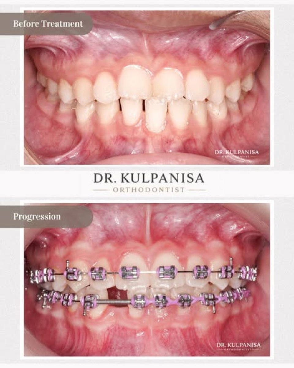 Before and after braces treatment progress at Bangkok Dental Hospital, teeth alignment result