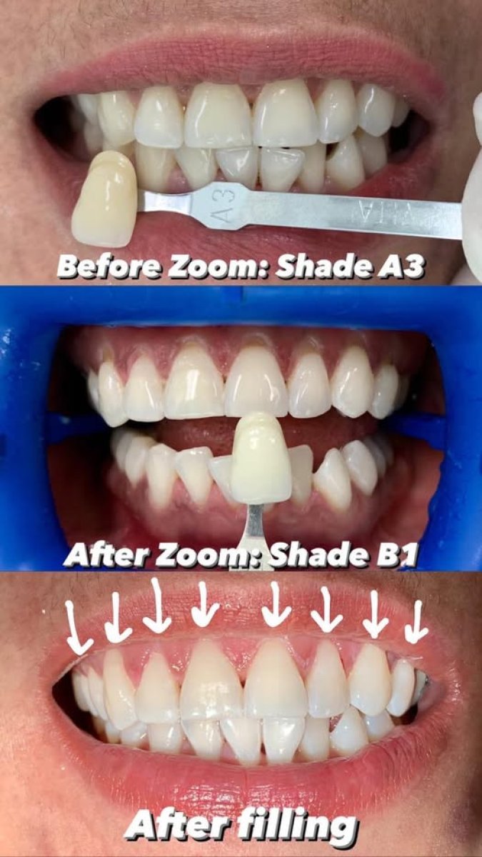 Composite filling and teeth whitening results at Bangkok Dental Hospital, brighter smile achieved